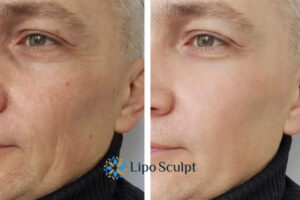 How to Fight Aging Symptoms 3 Fight Aging Symptoms Datchet With HIFU and Morpheus8 Today!