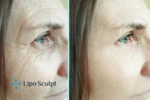 How to Fight Aging Symptoms 2 Do you want to Fight Aging Symptoms Datchet? Contact Lipo Sculpt today!