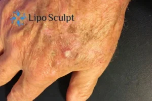 Best Actinic Keratoses Removal 2 Improve your wellbeing and health with Actinic Keratoses Datchet removal.treatment